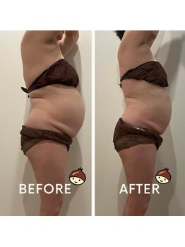 まろん鍼灸接骨院 立川店/痩身エステ（上半身）