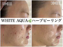 ホワイトアクア 梅田本店(WHITE AQUA)/ハーブピーリングでニキビケア
