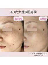 モモイロ(momoiro)/シミケア20分/効果の早い方♪