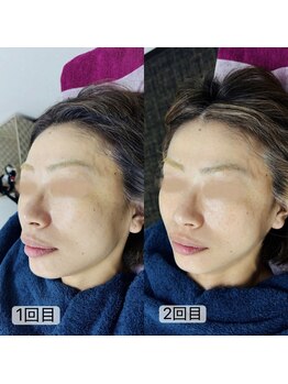 トゥインクル(Twinkle)/キレイなフェイスライン♪