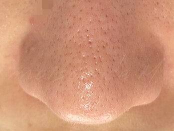 メゾン ド エム(maison de M)の写真/繰り返す毛穴悩みを丁寧にリセット☆プロの施術でキメを整え、なめらか肌へ導く結果重視の毛穴ケア♪