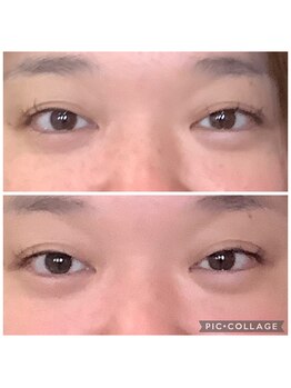 かず整骨院/光美容で目の開きがスッキリ!