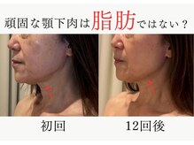 エレミュー 烏丸(Elemue.)の雰囲気（顎下の悩みの原因教えます★）