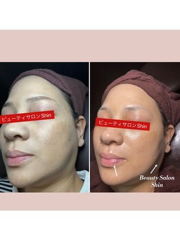シン(Shin)/【シミ改善フェイシャル】