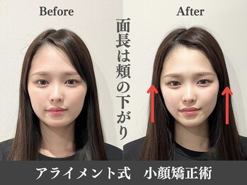 アライメント 自由が丘(Alignment)/面長の改善♪