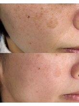 シェアキ(Chez Aki)/シミケアBefore/After