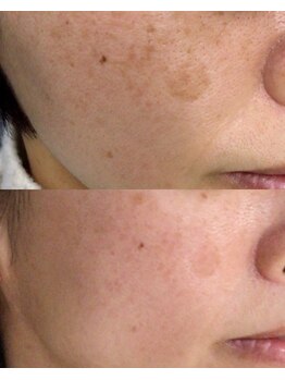 シェアキ(Chez Aki)/シミケアBefore/After