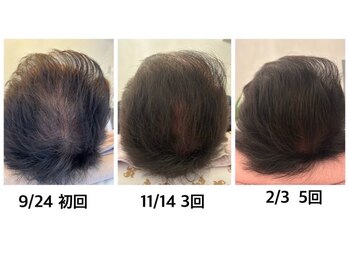 マーブル 熊本合志店/育毛促進【50代男性】