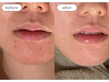 リスタ(RSTA)/【BEFORE/AFTER】