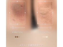 フリュール(FLEUR)の雰囲気（ルメラ黒ずみケア/ひじやひざの色素沈着を改善♪夏前の美白ケア）