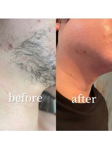 ムート(Mut.)/男性ヒゲワックス＋光脱毛。