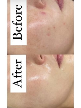 カルディエ(Cardie)/肌質改善　ビフォーアフター