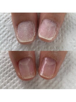 ジェルで傷んだお爪からうる艶へ