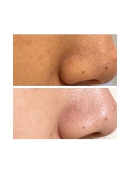 ノノサロン(nono salon)/毛穴洗浄