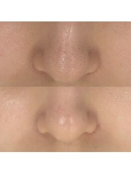 ラルーナ(La Luna)の写真/肌の負担を考慮したオリジナル施術！【幹細胞導入付き毛穴洗浄】透明感抜群の毛穴レス美肌で自分に自信を♪