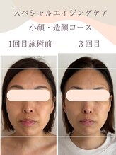 シンナリ(Shinnari)/before→after　3回目