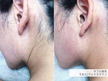 クリード(CLEAD)/うなじダブル脱毛/6000円