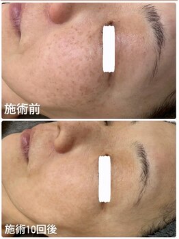 ナナラ/速攻シミケア