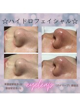 アイリープ(eyeleap)/☆ハイドロフェイシャル