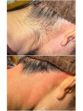 エースタイル(A-style.)/うなじ☆シュガーリング脱毛