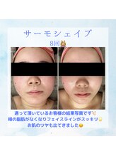 Nビューティー/最新RFサーモシェイプオーパス