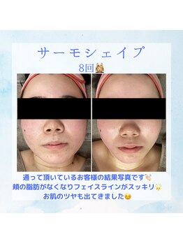 Nビューティー/最新RFサーモシェイプオーパス