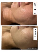 ディオーネ 湘南藤沢店(Dione)/ハーブフェイシャ◆ニキビケア