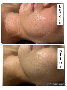 ディオーネ 湘南藤沢店(Dione)/ハーブフェイシャ◆ニキビケア