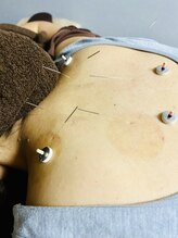 はりめぐり/鍼灸