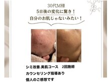 ココ(KOKO)/施術後も5日後も!!