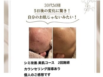 ココ(KOKO)/施術後も5日後も!!
