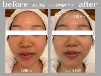 アイレ 桑名(aire)/スキンケア迷子/美白/毛穴