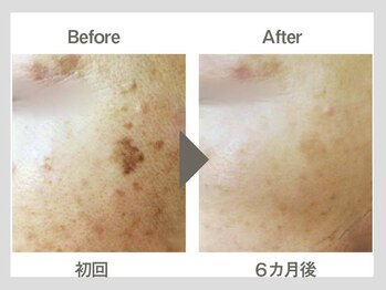 ビューティーリバース 相模大野店/シミケア美白！オセロマシン