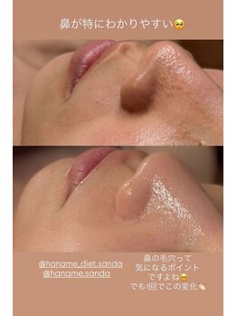 ハナメ(HANAME)の写真/あなたに合ったフェイシャルメニューで♪気になるのは毛穴？くすみ？たるみ？