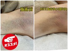 ケイナイン(K-NINE)/大人気両ワキ脱毛