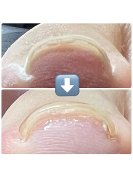 ループ(LOOP)/最新巻き爪ケア！