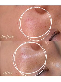 シュカ(Shuka)/ハーブピーリング