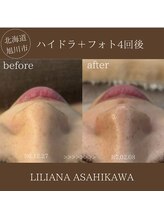 リリアーナ アサヒカワ(LILIANA ASAHIKAWA)/ハイドラ毛穴洗浄＋光フォト