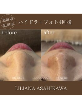 リリアーナ アサヒカワ(LILIANA ASAHIKAWA)/ハイドラ毛穴洗浄＋光フォト