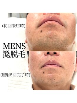 ヒパヒパ(Hipahipa!)/MENS髭脱毛☆ 最新LED脱毛