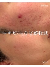 セレア(CELEA)/ニキビ改善/肌荒れ/ポテンツァ