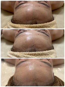 エルミナ.(elmina.)/額のハリつや変化　脂肪増殖５ml