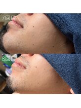 カナウ(KANAU)/ヒゲ脱毛（20代前半男性）