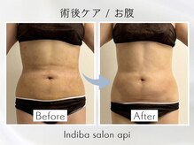 アピ(api)/症例写真【インディバ】