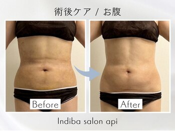 アピ(api)/症例写真【インディバ】