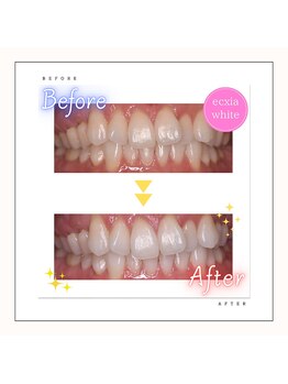 エクシアホワイトニング 麻布十番店/【Ecxiaホワイトニング】症例