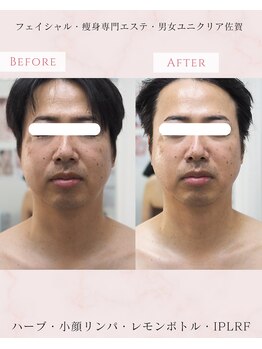 ユニクリア(Uni clear)/佐賀市│メンズフェイシャル