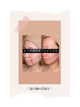 ブリラ(Briller)/国産ヒト幹細胞導入フェイシャル