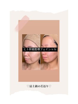 ブリラ(Briller)/国産ヒト幹細胞導入フェイシャル