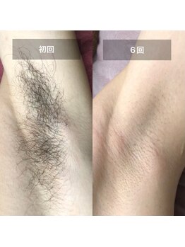 カウピリ(kaupili)/【脱毛】ビフォーアフター